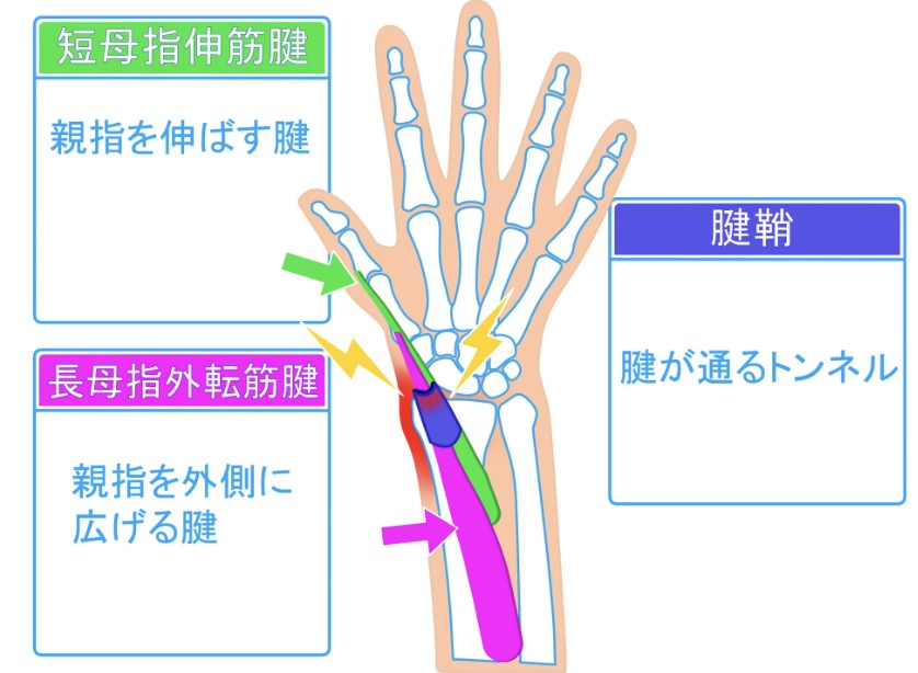 プログラマーの腱鞘炎対策1